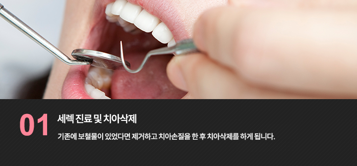 -세렉 진료 및 치아삭제
기존에 보철물이 있었다면 제거하고 치아손질을 한 후 치아삭제를 하게 됩니다.
